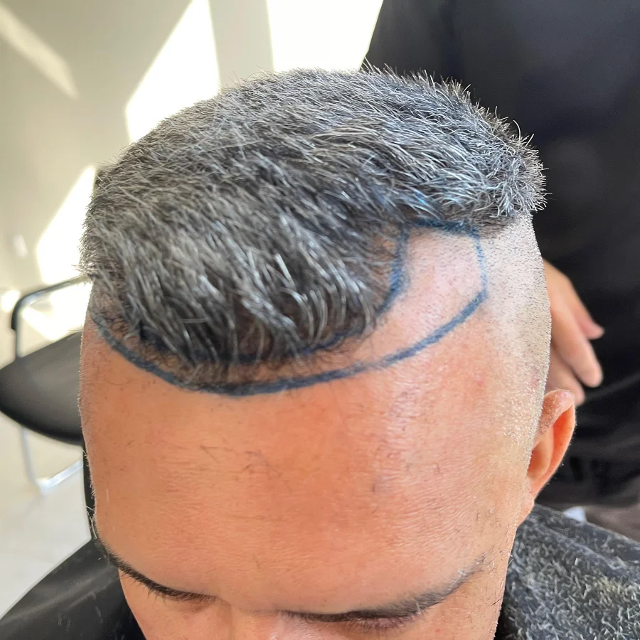 Paciente com a nova linha frontal marcada, antes do transplante
