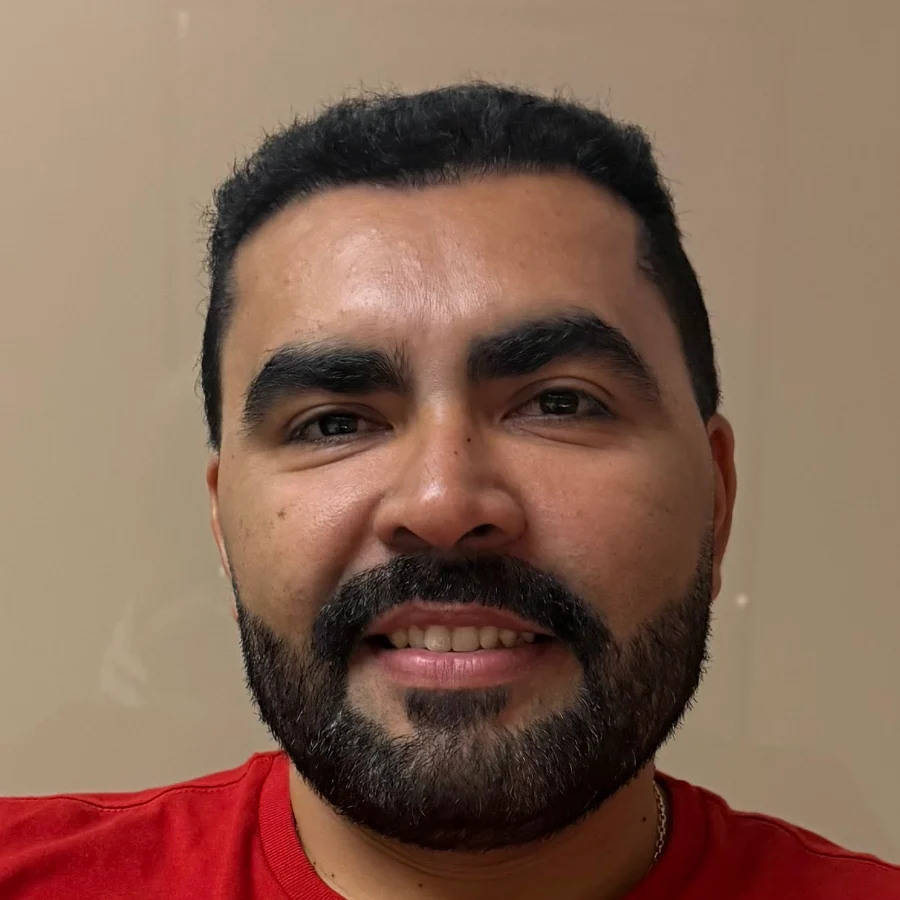 O mesmo paciente depois do transplante capilar