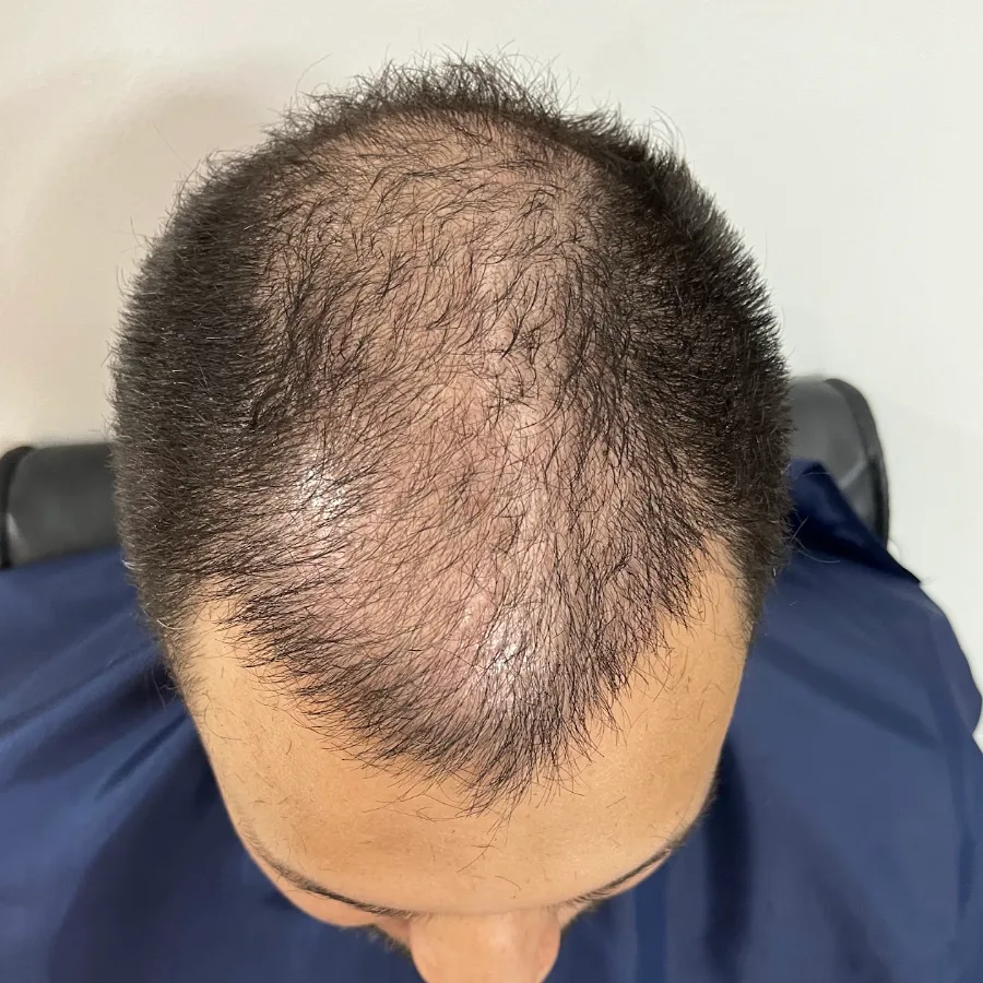 Topo da cabeça com fios ralos, antes do transplante