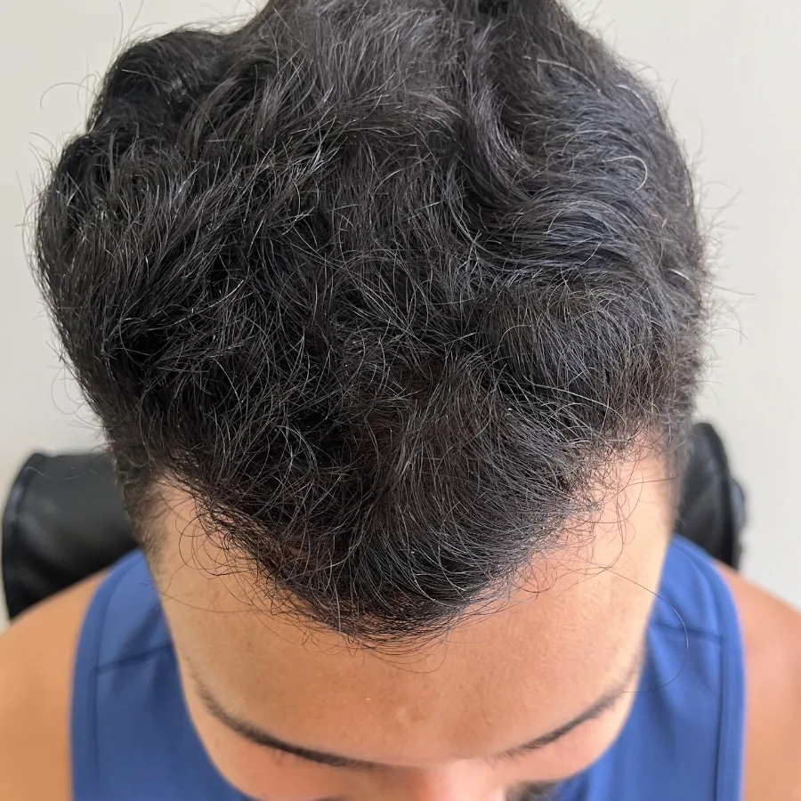 Topo da cabeça com fios densos, depois do transplante