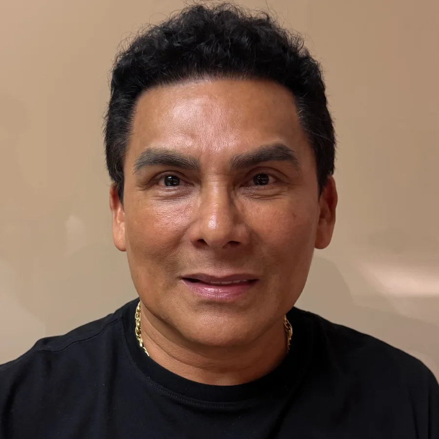 O mesmo paciente depois do transplante capilar