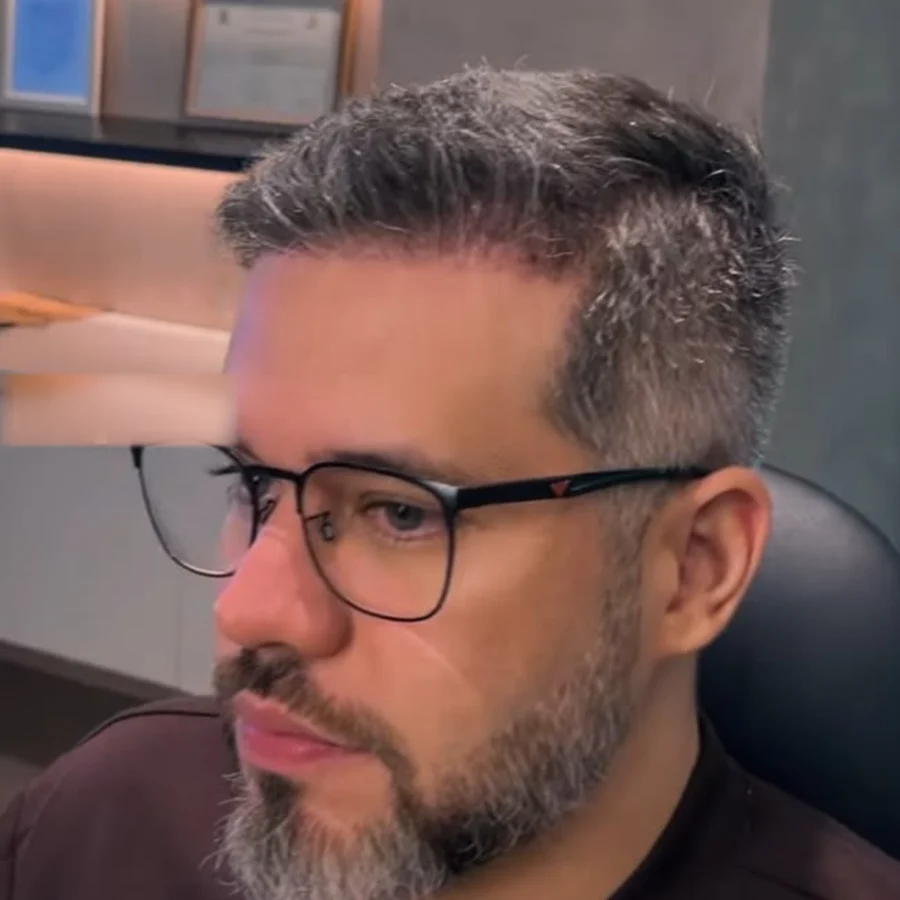 O mesmo paciente depois do transplante capilar
